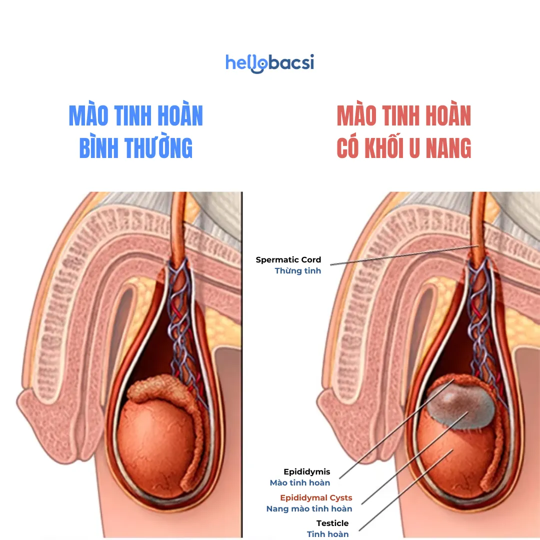 Nang mào tinh hoàn là gì? Bệnh có nguy hiểm không?