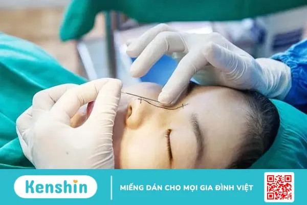 Nâng mũi bằng chỉ: Mũi đẹp không cần phẫu thuật