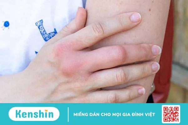 Ngón tay bị sưng là do đâu và cách chữa trị hiệu quả