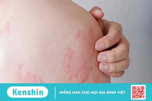 Ngứa nổi mề đay toàn thân: Nguyên nhân và cách điều trị