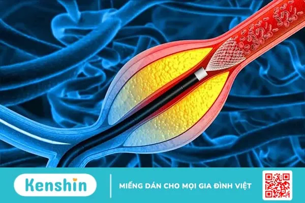 Người đặt stent mạch vành sống được bao lâu?