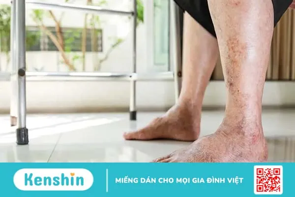 Người già bị phù chân phải làm sao?