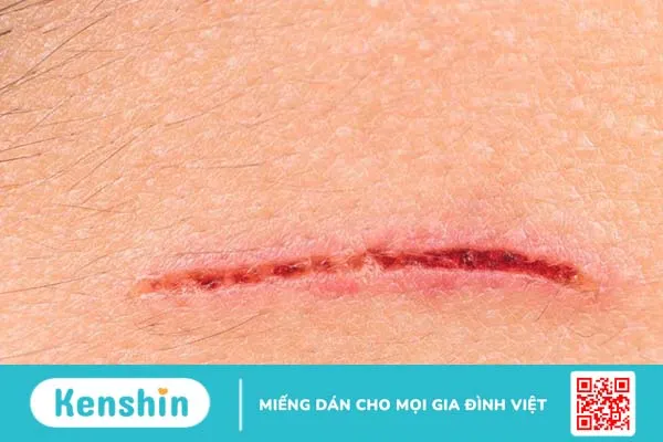 Người nhiễm HIV vết thương có lành không? Làm sao để biết mình có bị HIV không?