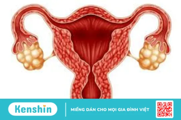 Người thừa cân béo phì liệu có thể nhanh mang thai?