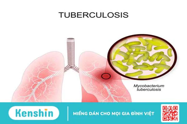 Nguyên nhân bệnh lao phổi là gì? Các yếu tố nguy cơ và cách phòng tránh