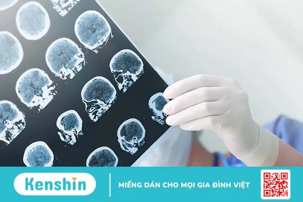 Nguyên nhân động kinh là gì? Bệnh động kinh có di truyền không?