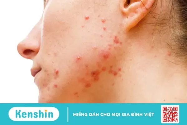 Nguyên nhân gây mụn ở từng vị trí và cách khắc phục