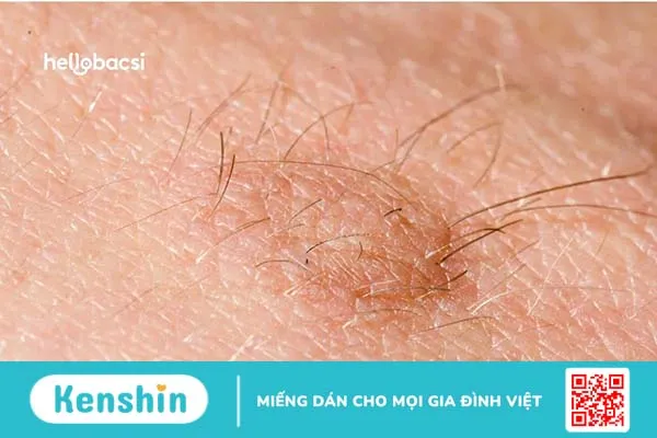 Nguyên nhân gây nổi cục cứng ở vùng kín và mép vùng kín nữ do đâu?