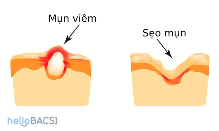 Nguyên nhân gây sẹo mụn và các biện pháp phòng tránh