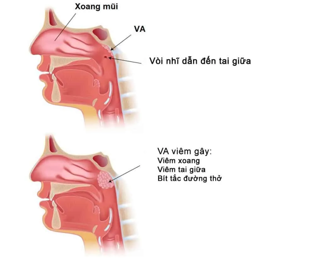 Nguyên nhân gây viêm VA (sùi vòm họng) là gì, điều trị thế nào?