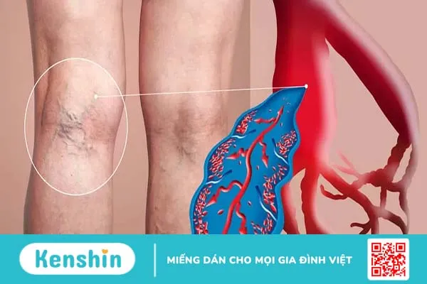 Nguyên nhân giãn tĩnh mạch chân là do đâu và phòng ngừa