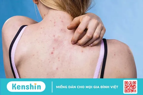 Nguyên nhân mụn lưng và 8 cách điều trị tại nhà hiệu quả