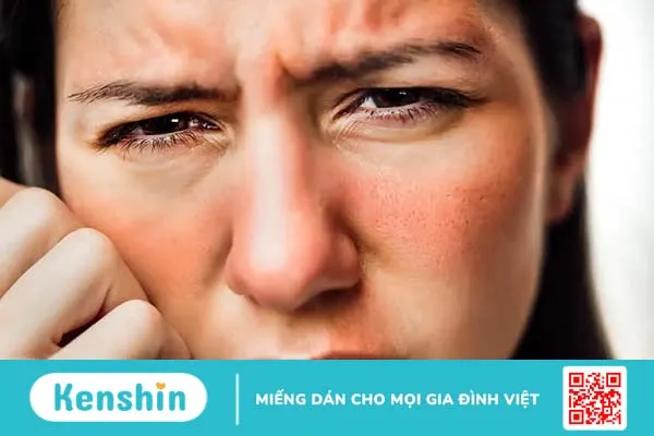 Nhận biết các dấu hiệu bị dị ứng da mặt và cách chăm sóc, điều trị đúng