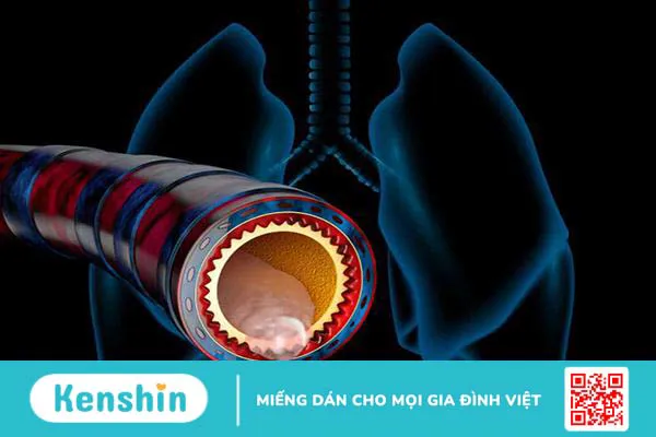 Nhận biết sớm dấu hiệu trẻ bị viêm phế quản cấp tính và mạn tính