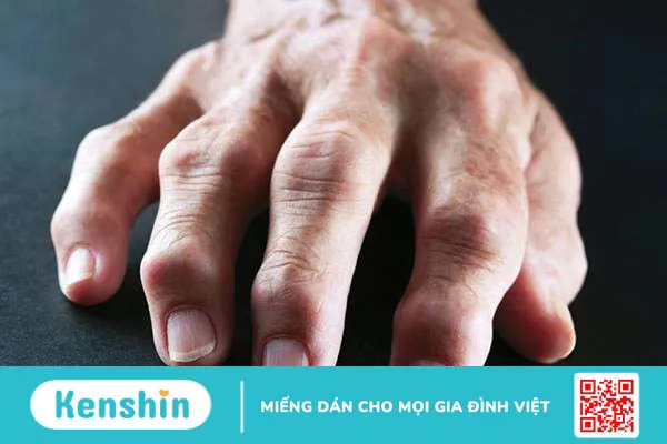 Nhận biết và điều trị viêm đa khớp dạng thấp theo từng giai đoạn