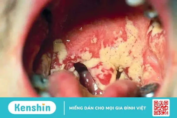 Nhiễm nấm Candida miệng: Nguyên nhân, dấu hiệu, điều trị, phòng ngừa