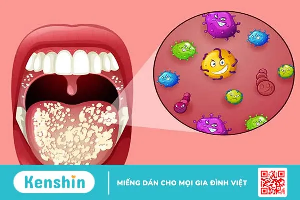 Nhiễm nấm Candida miệng: Nguyên nhân, dấu hiệu, điều trị, phòng ngừa