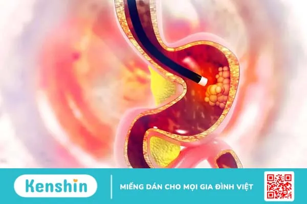 Nhiễm vi khuẩn HP là gì? Triệu chứng và các nguy cơ không thể xem nhẹ