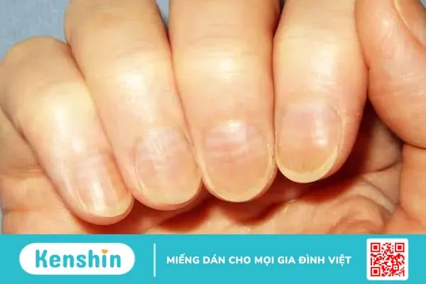 Nhìn móng tay đoán bệnh chỉ trong 1 phút