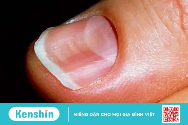 Nhìn móng tay đoán bệnh chỉ trong 1 phút