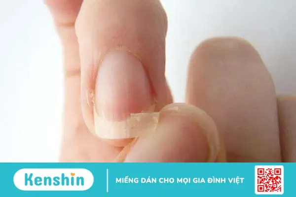 Nhìn móng tay đoán bệnh chỉ trong 1 phút