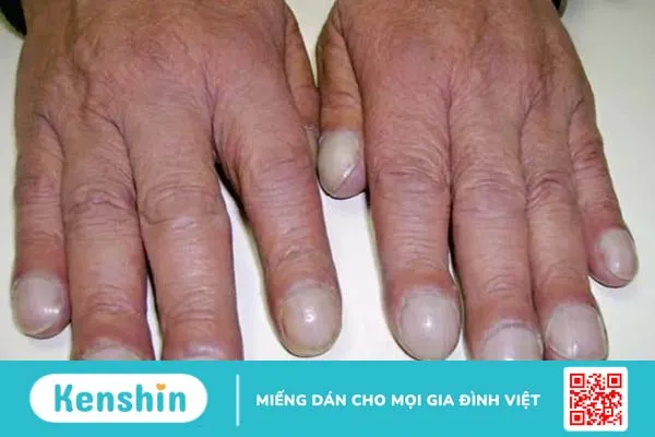 Nhìn móng tay đoán bệnh chỉ trong 1 phút