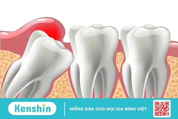 Nhổ răng khôn bao lâu thì lành? Để vết thương nhanh lành, cần chú ý gì?