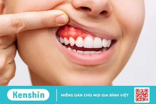 Nhổ răng khôn hàm trên có nguy hiểm hơn hàm dưới? Có nên nhổ không?