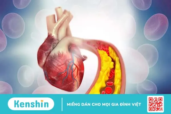 Nhồi máu cơ tim thất phải