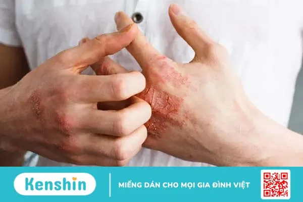 Những bệnh tự miễn ngoài da phổ biến