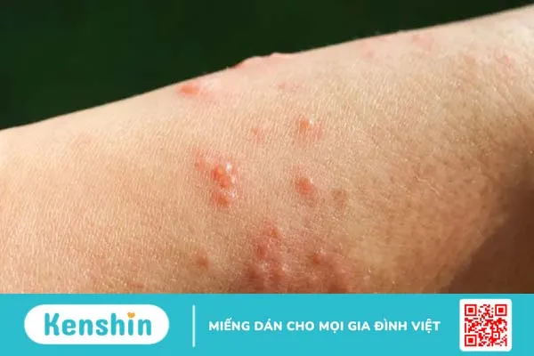 Những bệnh tự miễn ngoài da phổ biến