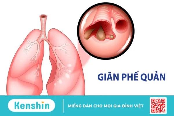 Những biến chứng lao phổi nguy hiểm mà người bệnh lao cần biết