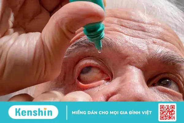 Những câu hỏi thường gặp về bệnh glaucoma (cườm nước)