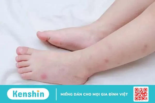 Những dấu hiệu cảnh báo bệnh sốt xuất huyết ở trẻ em và cách điều trị