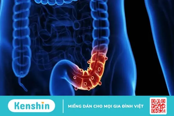 Những điều bạn chưa biết về bệnh viêm túi thừa manh tràng