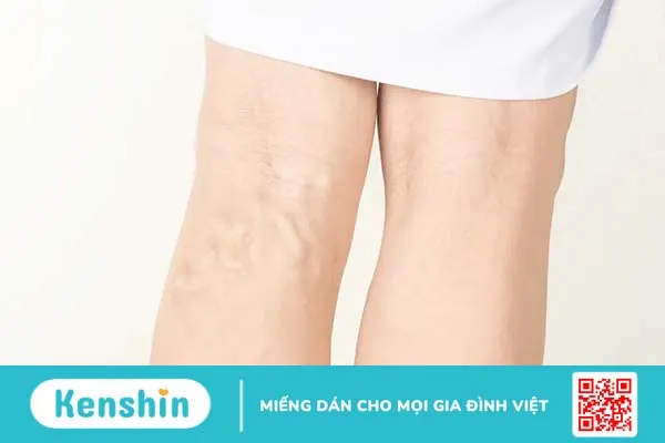 Những điều cần biết khi phẫu thuật giãn tĩnh mạch thừng tinh