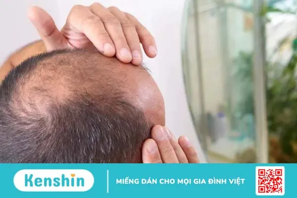 Những điều cần biết về rụng tóc ở nam giới