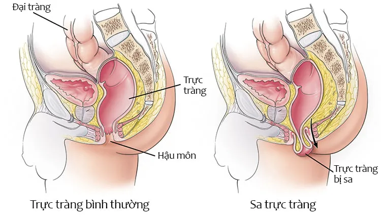 Những điều nên biết về phẫu thuật sa trực tràng