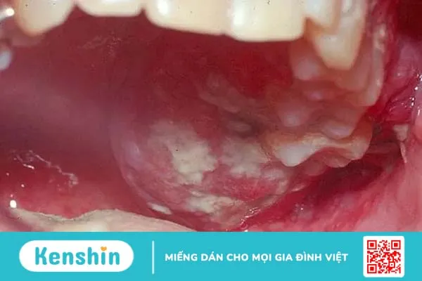 Những hình ảnh ung thư khoang miệng giúp phát hiện bệnh từ sớm