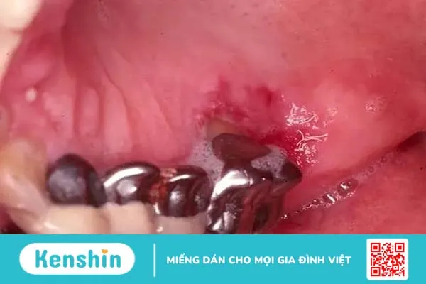 Những hình ảnh ung thư khoang miệng giúp phát hiện bệnh từ sớm