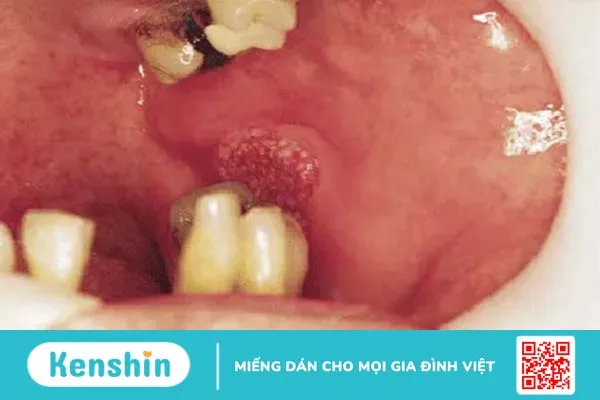 Những hình ảnh ung thư khoang miệng giúp phát hiện bệnh từ sớm