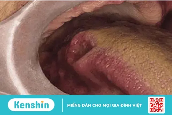 Những hình ảnh ung thư khoang miệng giúp phát hiện bệnh từ sớm