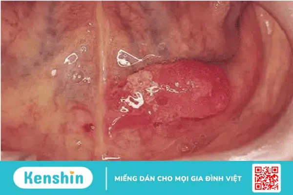 Những hình ảnh ung thư khoang miệng giúp phát hiện bệnh từ sớm