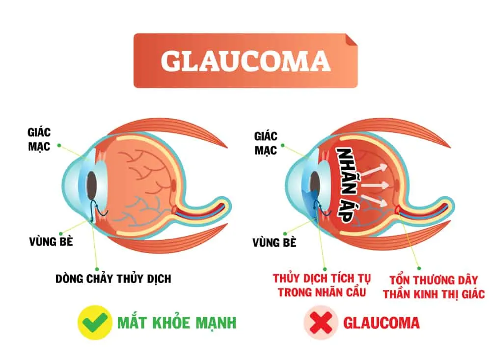 Những nguyên nhân bị cườm nước (glaucoma) bạn không thể bỏ qua