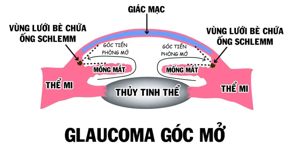 Những nguyên nhân bị cườm nước (glaucoma) bạn không thể bỏ qua