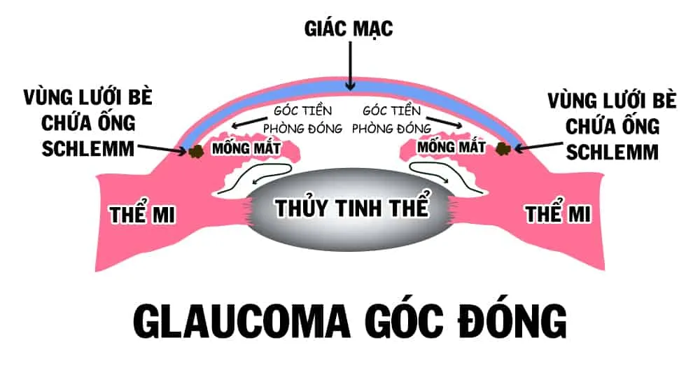 Những nguyên nhân bị cườm nước (glaucoma) bạn không thể bỏ qua