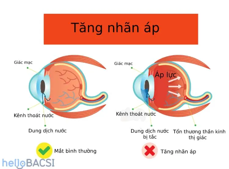 Những phương cách điều trị tăng nhãn áp phổ biến