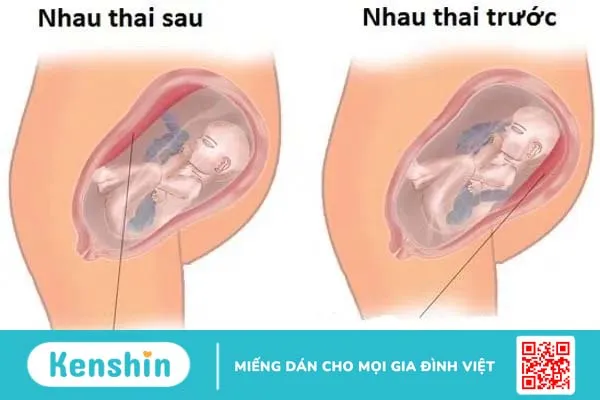 Những vấn đề cần biết về tình trạng nhau thai bám mặt trước