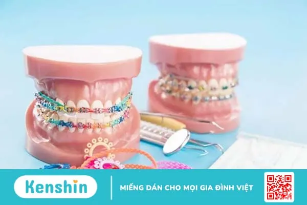 Niềng răng làm thay đổi khuôn mặt: Liệu bạn có mũi cao và cằm V line?