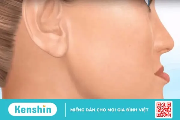 Niềng răng móm có đau không? Gương mặt bạn được cải thiện thế nào?